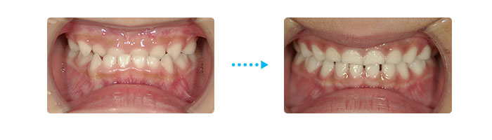 ３歳の男の子の逆になった噛み合わせ（反対咬合）が改善した例