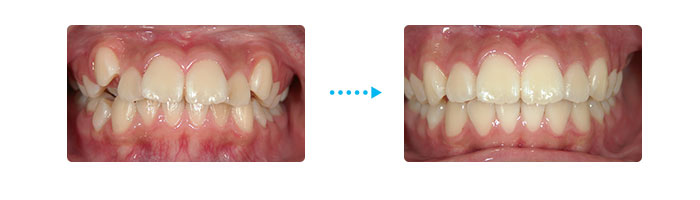 出っ歯、八重歯が改善した例