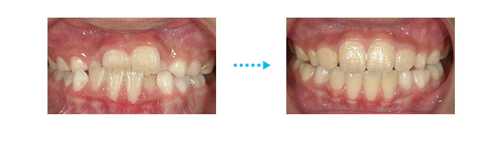 上の歯がガタガタしている状態、上下の歯の噛み合わせが反対（反対咬合）が改善した例
