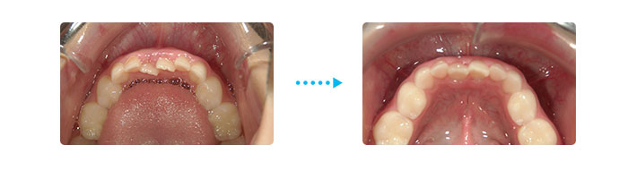 期間７カ月 状態：ＭＦＴの歯列への効果 下の前歯のガタガタが改善