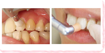 歯ブラシでは取りきれない歯のすみずみ、更には歯茎の中まで磨きあげます！