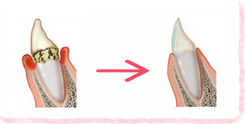 歯がツルツルになることで、むし歯、歯周病の原因であるバイオフィルムが付きにくくなります！