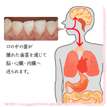 歯ぐきの炎症を抑える効果があるので、口腔から体内への細菌の侵入をブロック！全身の病気の予防にも効果的です。