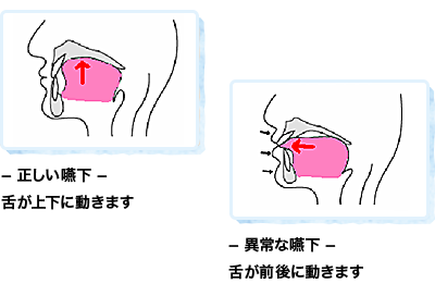 正しい嚥下 舌が上下に動きます 異常な嚥下 舌が前後に動きます