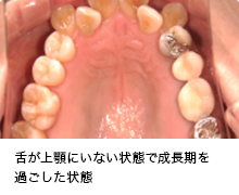 舌が上顎にいない状態で成長期を過ごした状態