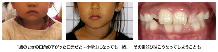 1歳のときの口角が下がった口元だと…小学生になっても一緒。その歯並びはこうなってしまうことも