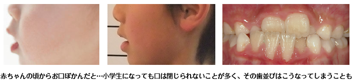 赤ちゃんの頃からお口ぽかんだと…小学生になっても口は閉じられないことが多く、その歯並びはこうなってしまうことも