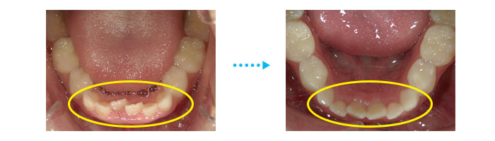 歯並び経過