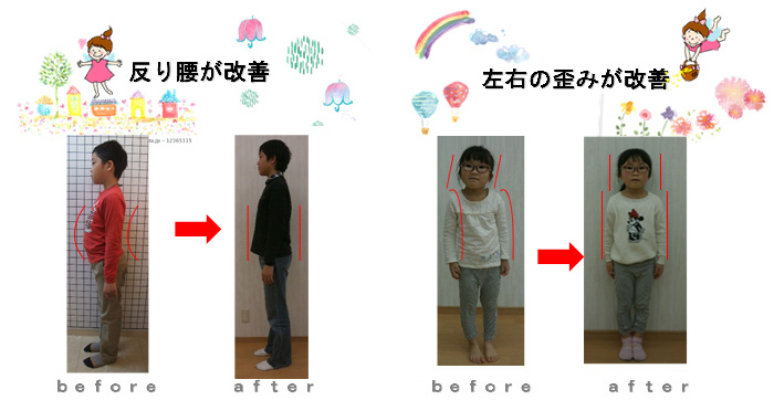 反り腰が改善　左右の歪みが改善