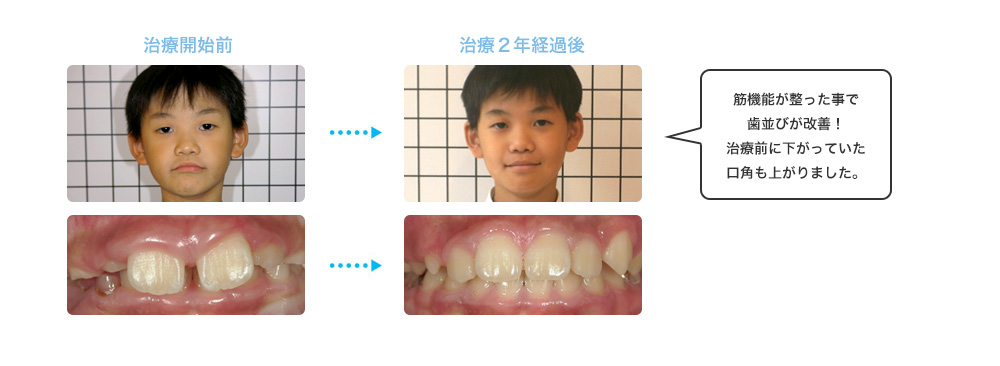 筋機能が整った事で歯並びが改善！治療前に下がっていた口角も上がりました。