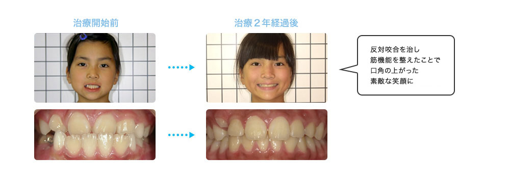 反対咬合を治し、筋機能を整えたことで口角の上がった素敵な笑顔に