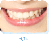 MFT(口腔筋機能療法)Before After