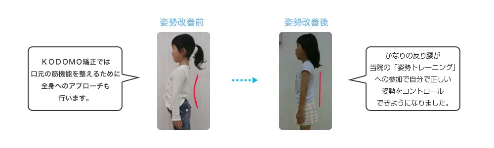 KODOMO矯正では口元の筋機能を整えるために全身へのアプローチも行います。かなりの反り腰が、当院の「姿勢トレーニング」への参加で自分で正しい姿勢をコントロールできるようになりました。